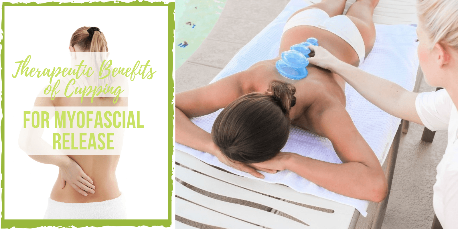 Therapeutic Benefits of Cupping for Myofascial Release